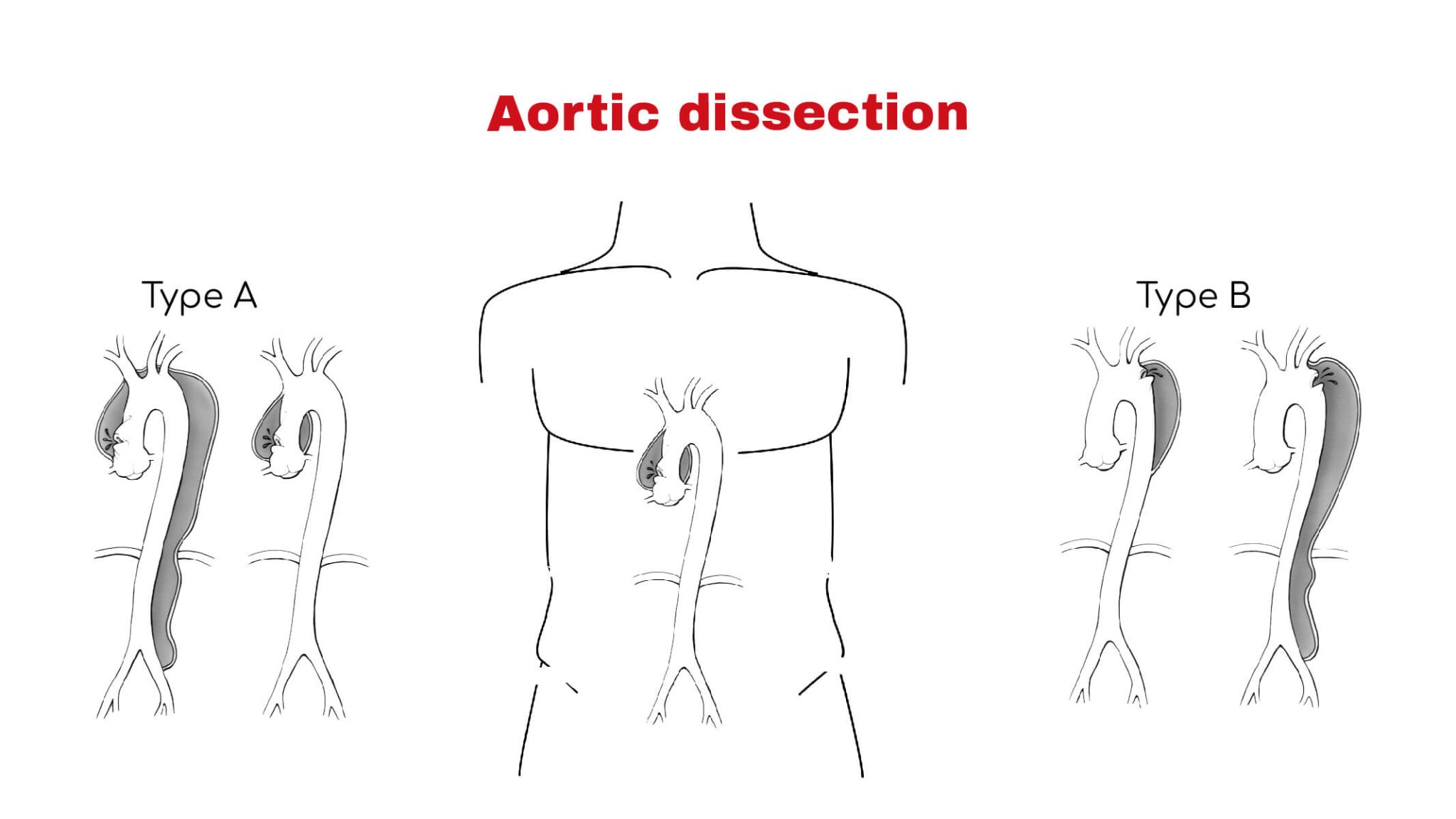 Aortic Dissection Chest Pain