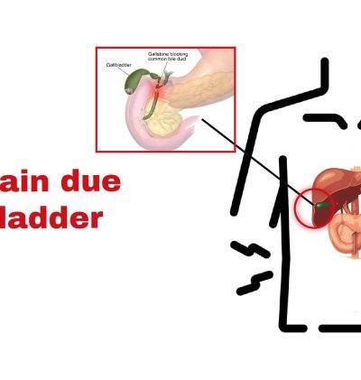 Chest pain due to gallbladder