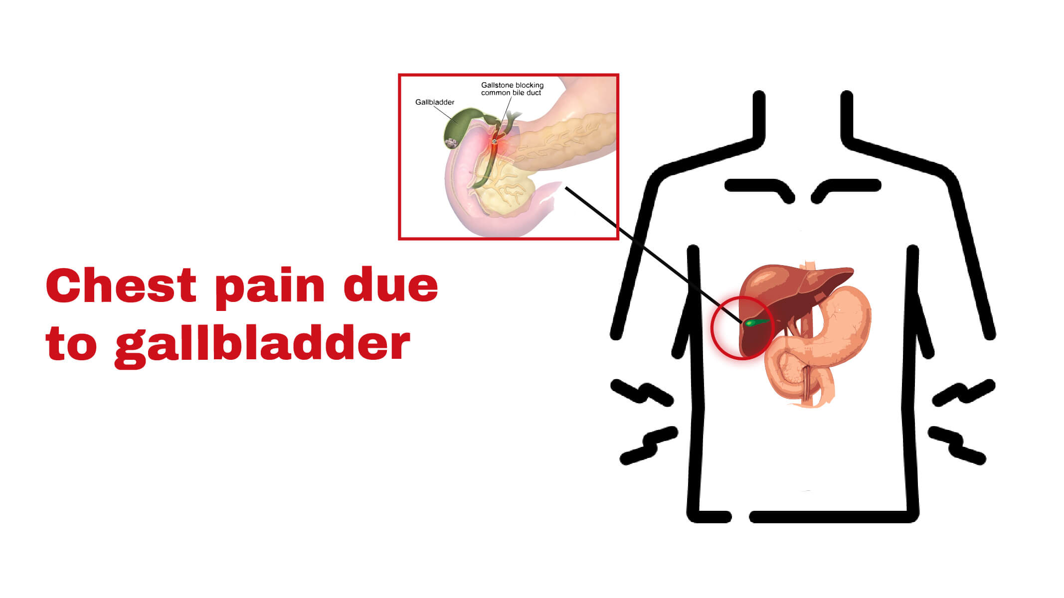 Chest pain due to gallbladder