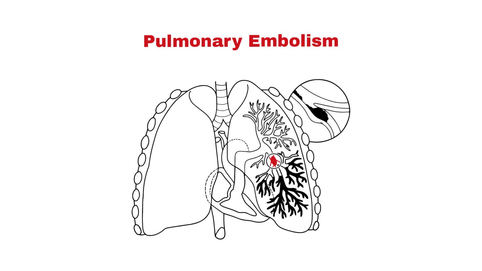 Pulmonary Embolism Chest Pain
