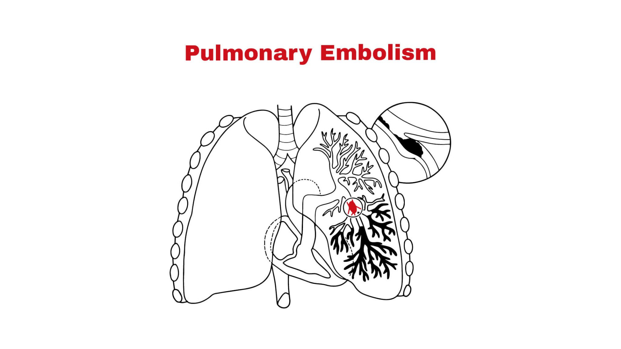 pulmonary-embolism-chest-pain