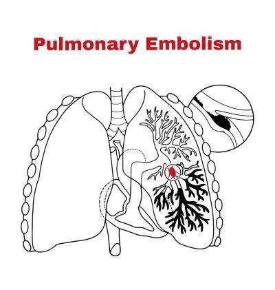 Pulmonary Embolism