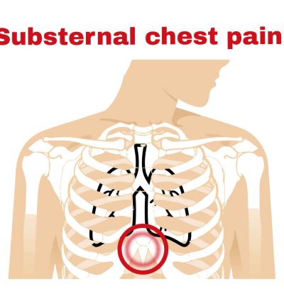 Substernal chest pain
