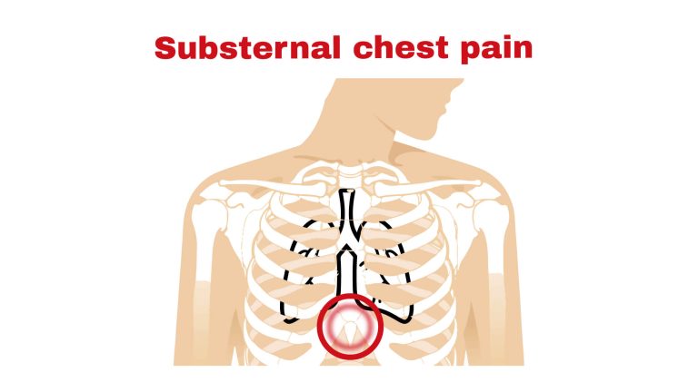 Substernal chest pain ~ Chest Pain