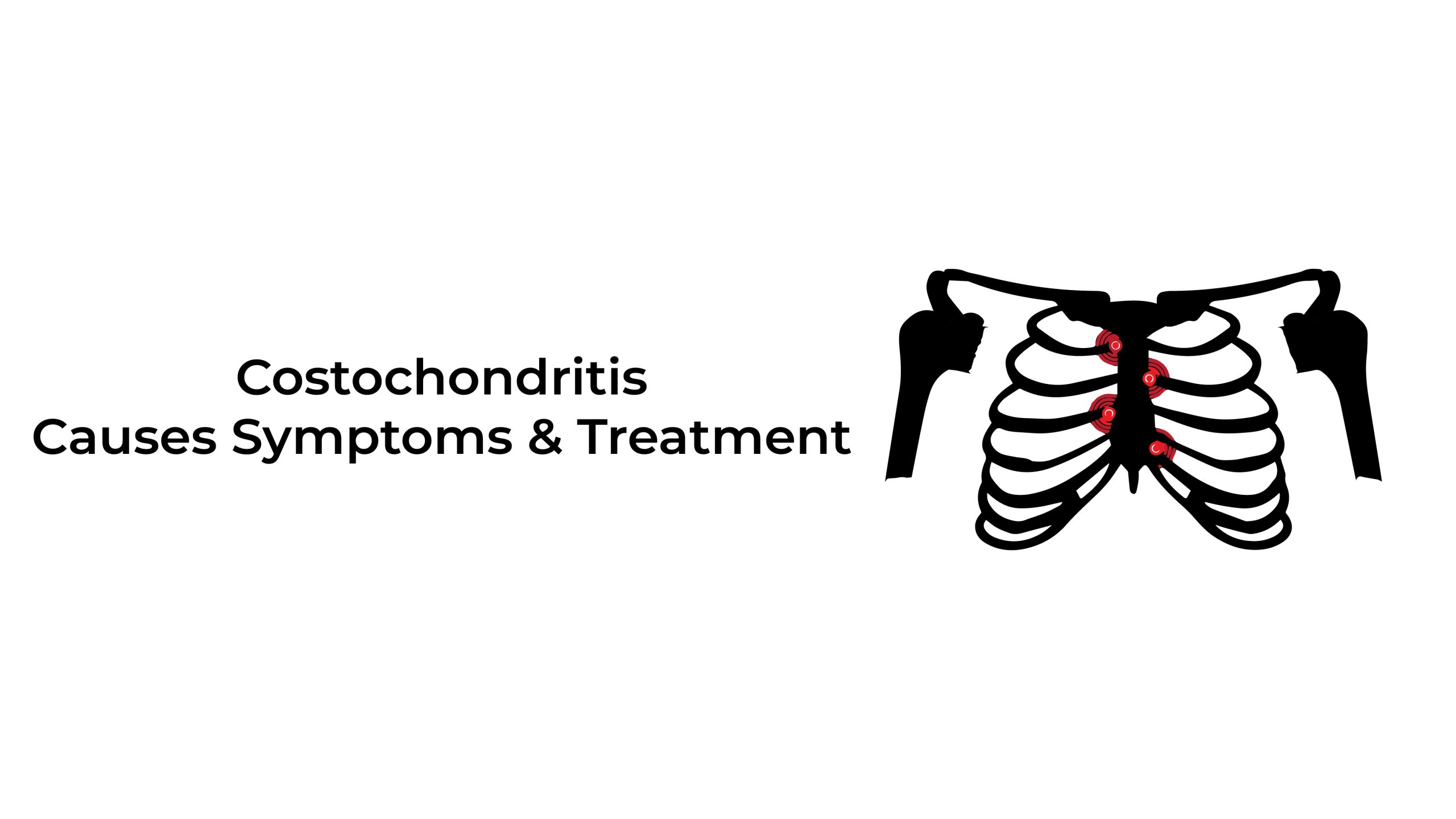 Costochondritis: Causes, Symptoms, And Treatment ~ Chest Pain